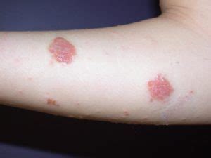 Discoid eczema | National Eczema Society