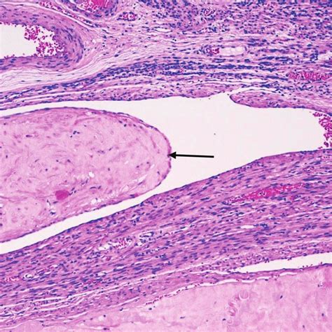 Microscopic appearance of intravenous leiomyomatosis in Patient 4 (H&E ...