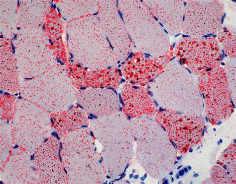 Pathology Outlines - Oil red O