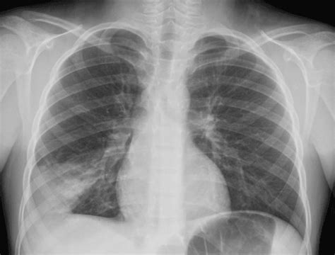 PEM Pearls: Chest Radiographs for Shortness of Breath