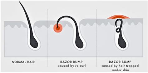 Razor bumps causes, prevention & learn how to get rid of razor bumps