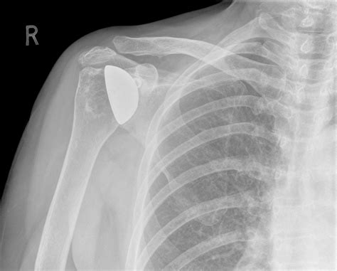 Shoulder Replacement Surgery: Treatment Advances and Alternatives