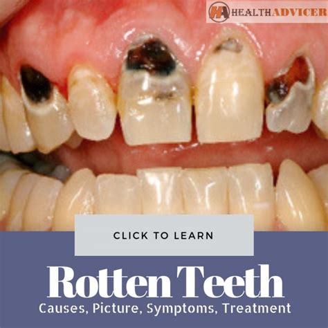 Rotten Teeth: Causes, Picture, Symptoms And Treatment