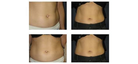 Best Belly Button Surgery Photos | Matthew Schulman, M.D. Plastic ...