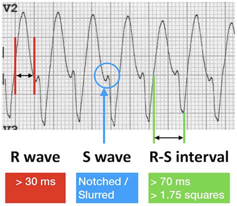 VT versus SVT • LITFL Medical Blog • ECG Library Basics