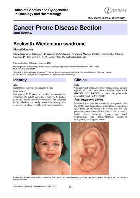 Beckwith Wiedemann Syndrome Adult