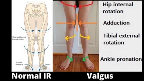 Internal Rotation Knee