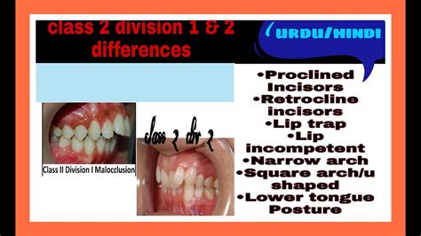 ANGLE'S CLASS 2 MALOCCLUSION DIVISION 1 & 2 CLINICAL FEATURES - YouTube