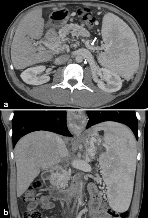 Percutaneous Splenorenal Shunt Creation in a Patient with Chronic ...