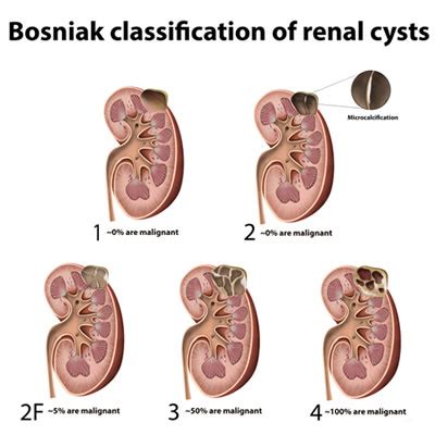 Kidney Cyst Ultrasound And Biopsy Procedure