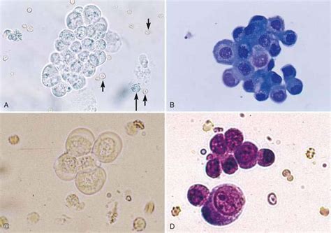 yeast urine sediment images