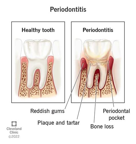 Periodontitis (Gum Disease): Symptoms, Stages & Treatment