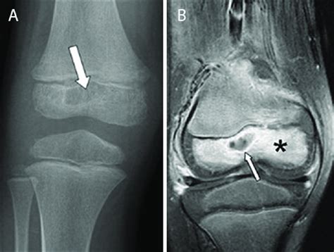 Distal Epiphysis Femur