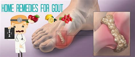 24 Natural Home Remedies For Gout Pain In The Leg, Finger & Elbow