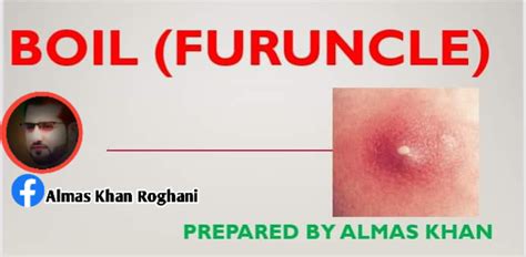 Boil / furuncle Causes Symptoms... - Almas Khan Roghani