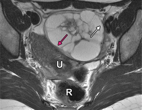 Female Pelvic Mri Uterus Mass