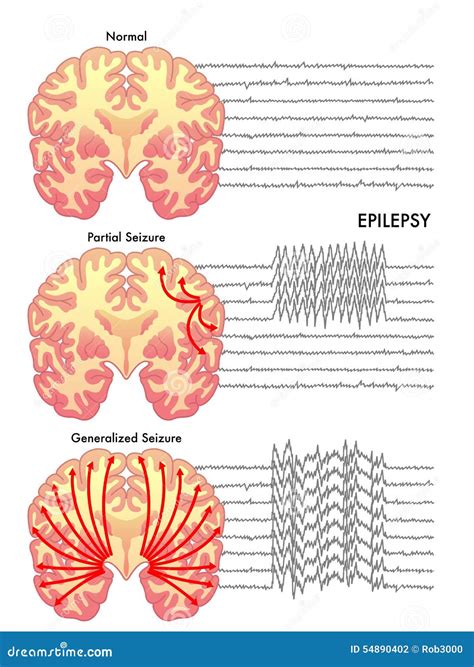 Epilepsy Stock Photo - Image: 54890402