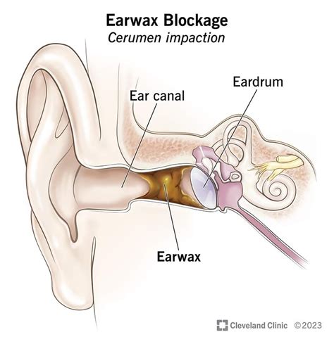 Earwax Blockage: Symptoms, Causes & Removal