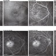 Bulls eye maculopathy of unknown etiology - Retina Image Bank