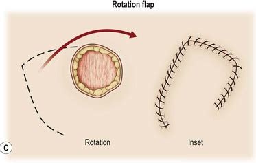 Flap classification and applications | Plastic Surgery Key