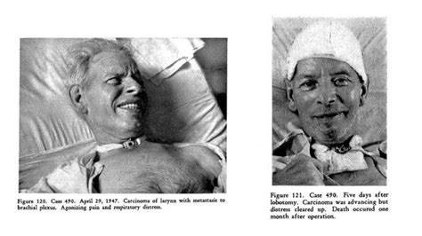 Lobotomy used as a palliative procedure, 'Psychosurgery' by Freeman and... | Download Scientific ...