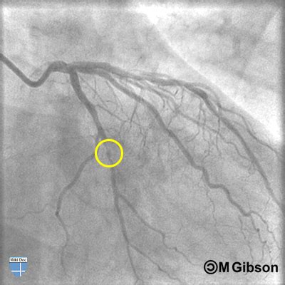 TIMI thrombus grade 1 - wikidoc