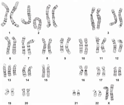 Trisomy 13 Diagram