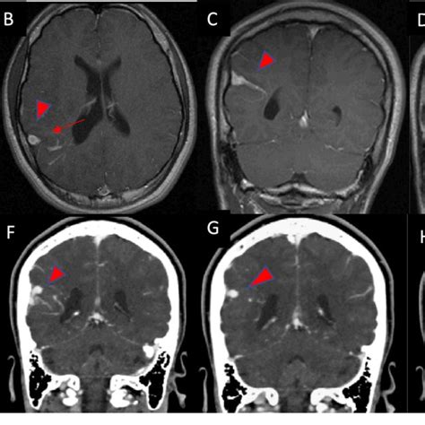 Axial postcontrast T1W MRI demonstrating a typical dural venous anomaly ...