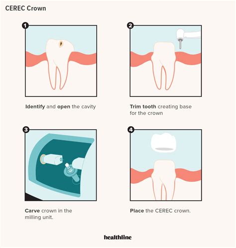 CEREC Crown Benefits, Cons, Costs, Procedure, and Alternatives