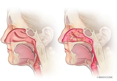 Rhinitis - La Crosse - Mayo Clinic Health System