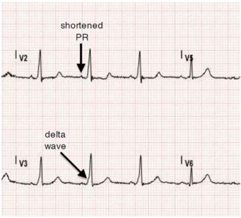 Pre-excitation syndrome - wikidoc