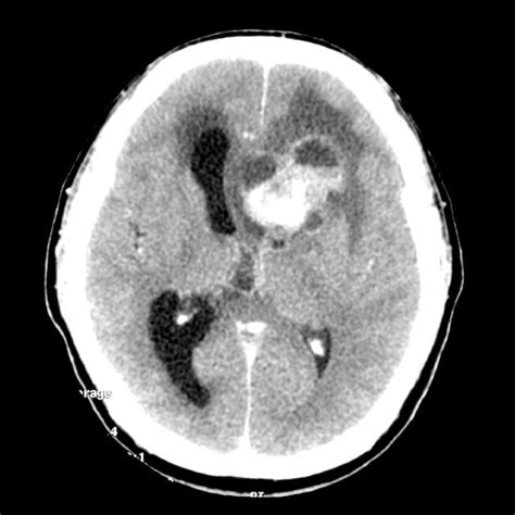 Ependymoma MRI - wikidoc