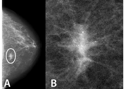 (a) A mammogram showing a stellate lesion and (b) a magnified image of... | Download Scientific ...