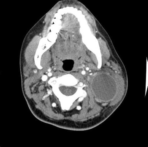 Branchial cleft cyst - wikidoc