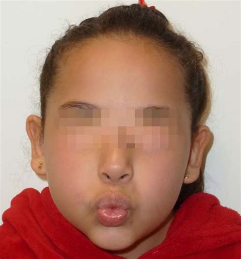 RBCP - Botulinum toxin in the treatment of asymmetric crying face syndrome: a case report