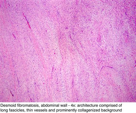 Pathology Outlines - Fibromatosis-desmoid