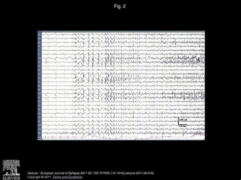 Seizure freedom with VNS monotherapy: A case report - ppt download