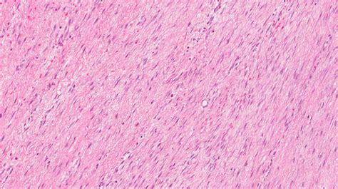 โรคไฟโบรมาโตซิส | MyPathologyReport.ca