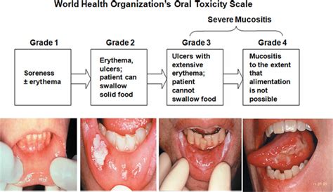 Oral mucositis definition, causes, symptoms, treatment guidelines ...