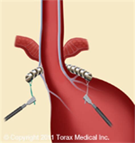 LINX Norwalk | Reflux Management System New London