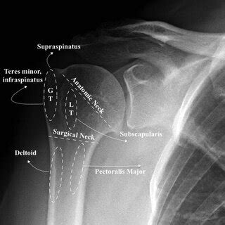 Axillary shoulder X-ray demonstrating a displaced fracture of the... | Download Scientific Diagram