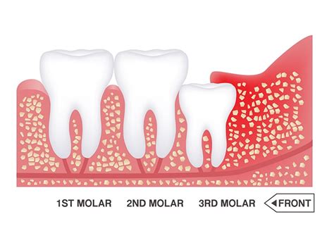 Wisdom teeth and dental braces: myths and realities