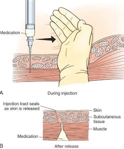 Z Track Injection