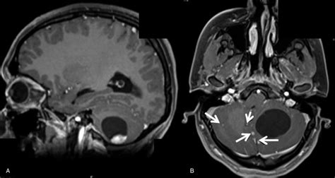 Magnetic resonance imaging showing a large, 4 Â 3 Â 3 cm posterior... | Download Scientific Diagram