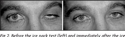 [PDF] Ice pack test in the diagnosis of myasthenia gravis. | Semantic Scholar