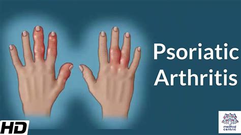 Psoriatic Arthritis, Causes, Signs and Symptoms, Diagnosis and ...