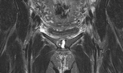 Coronal plane MRI showing oedema in the distracted symphysis with a ...