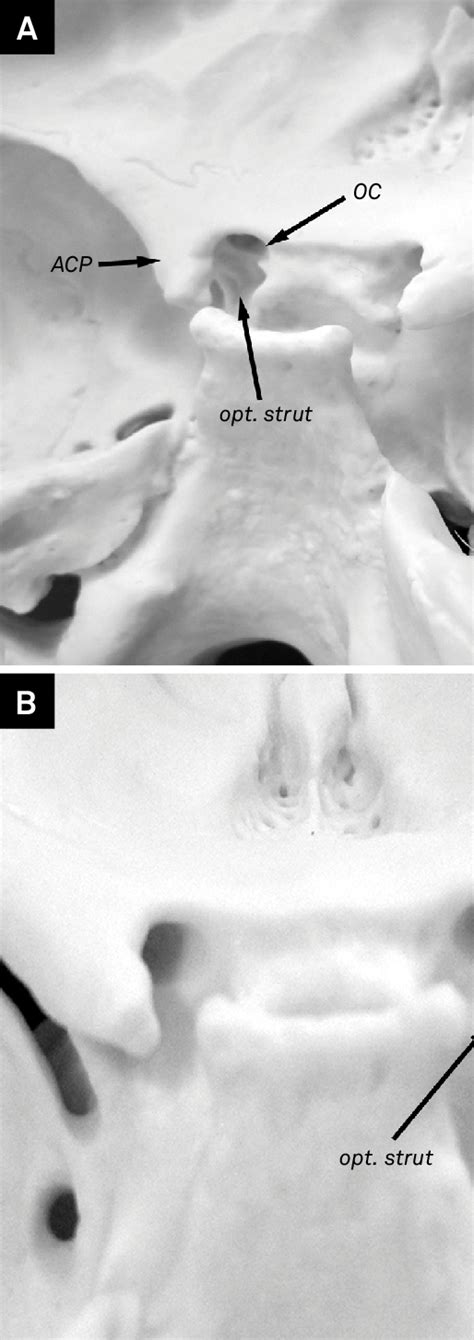 Bone anatomy of the anterior clinoid process region. (A) Lateral... | Download Scientific Diagram