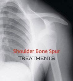 shoulder bone spur