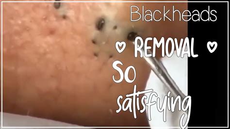 Blackheads removal... So satisfying - YouTube